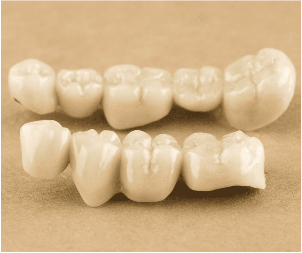 How Long Do Dental Bridges Last?