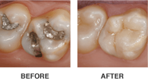 Before-and-after images showcasing the transformative effects of CEREC crowns, with the 'before' image depicting damaged or discolored teeth and the 'after' image revealing beautifully restored teeth with CEREC crowns.