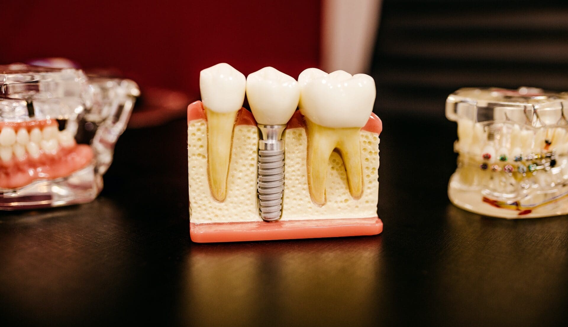 Model of a dental implant on a table