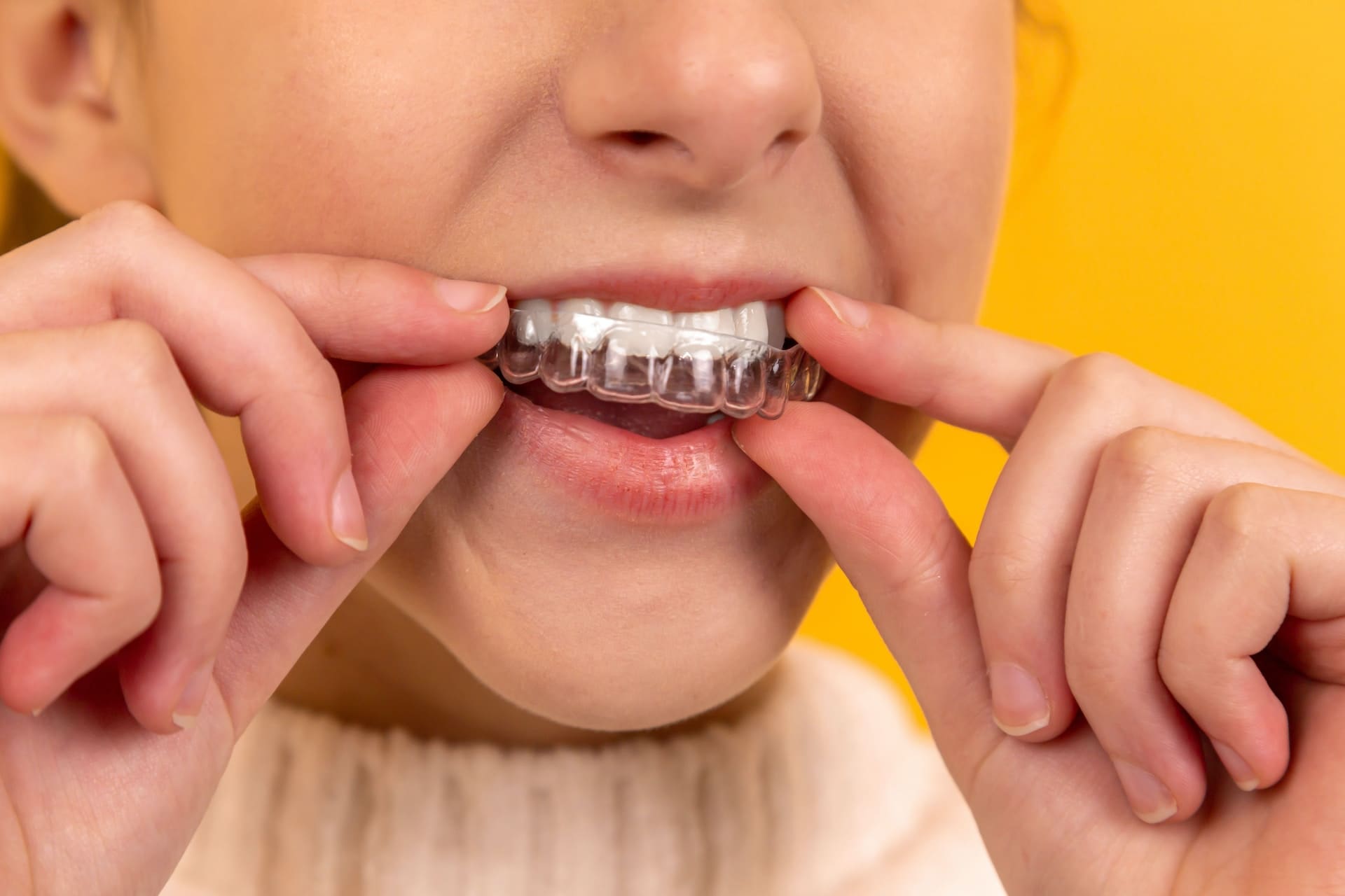 Close up of a person putting an Invisalign clear aligner over their upper teeth