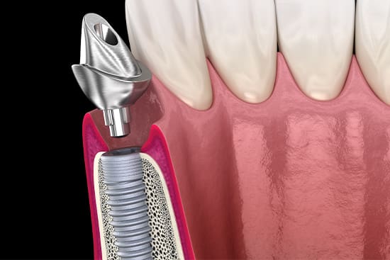 A digital illustration showing the parts of a dental implant