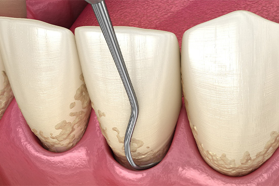A 3D illustration of the scaling and root planing process.