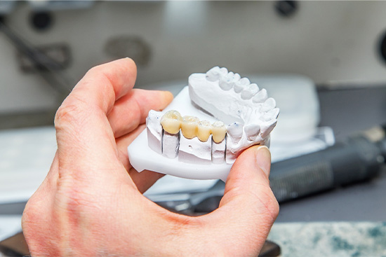 Dental bridge model showing crowns supporting replacement tooth.