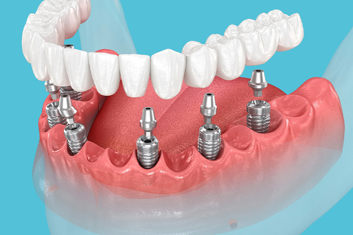 A 3D illustration of an implant denture and its parts.