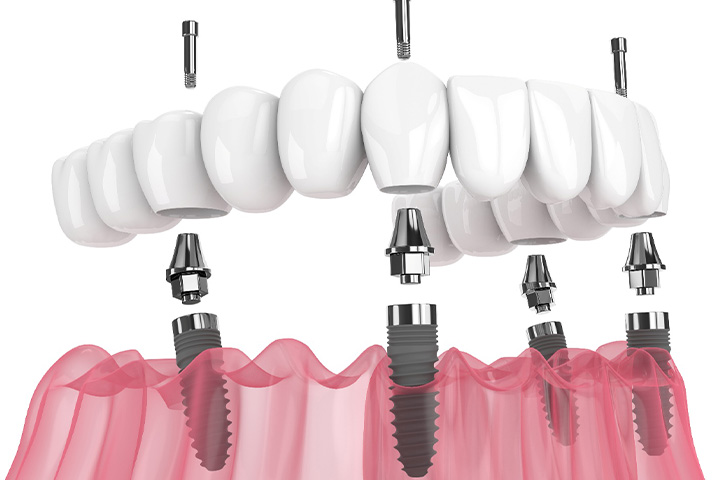 Digital image of an implant denture.