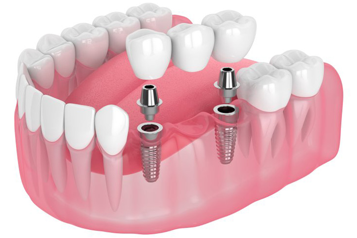 Exploded illustration of implant bridge.