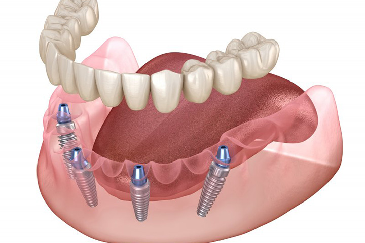 Exploded illustration of implant denture.