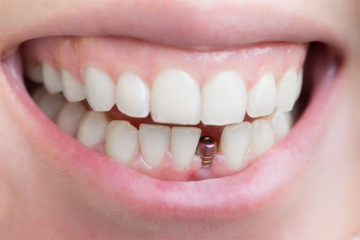 Smile with single dental implant.