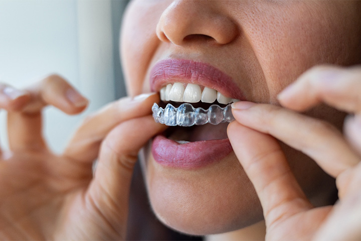 Closeup of patient putting on clear aligner.