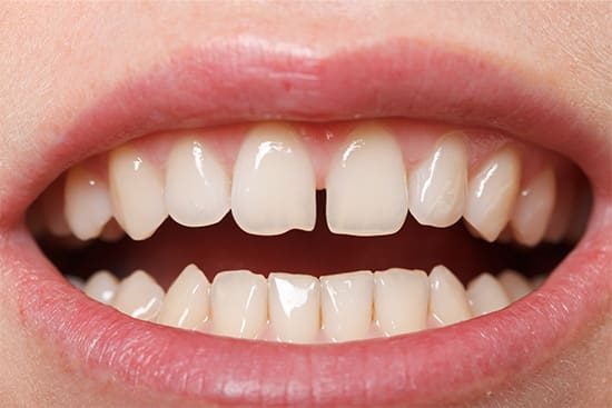 A close-up of a patient with a gap between their front teeth.