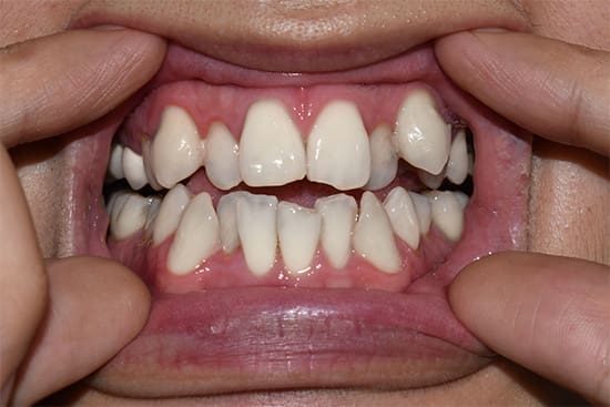 A close-up of a patient with crowded teeth.