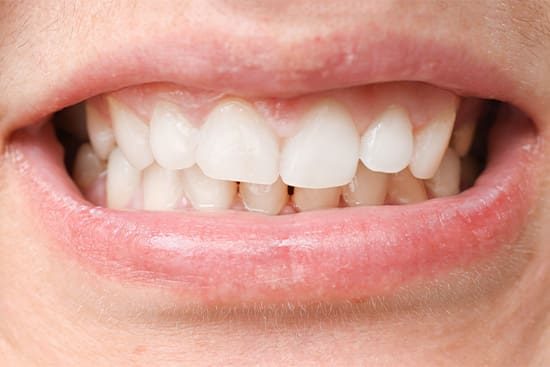 A patient with a misaligned bite.