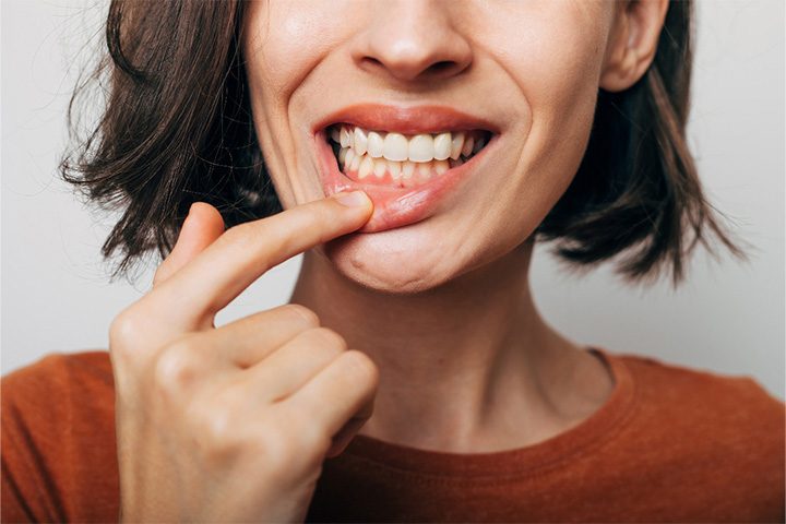 A woman revealing her red and inflamed gums.