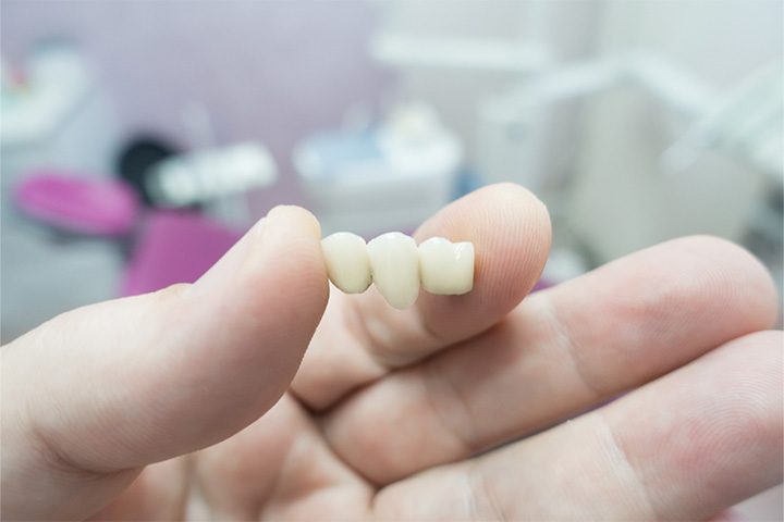 Close-up of dental bridge model in Danvers office.
