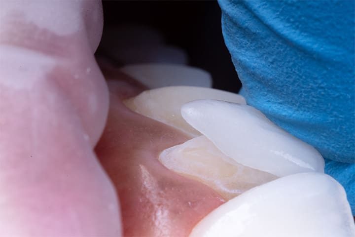 Up-close view of a dentist placing dental veneers